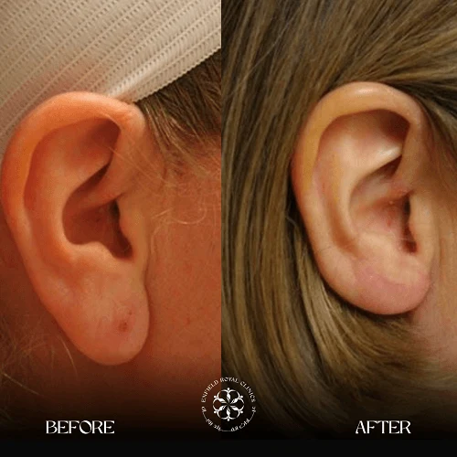 Ear reshaping before after images