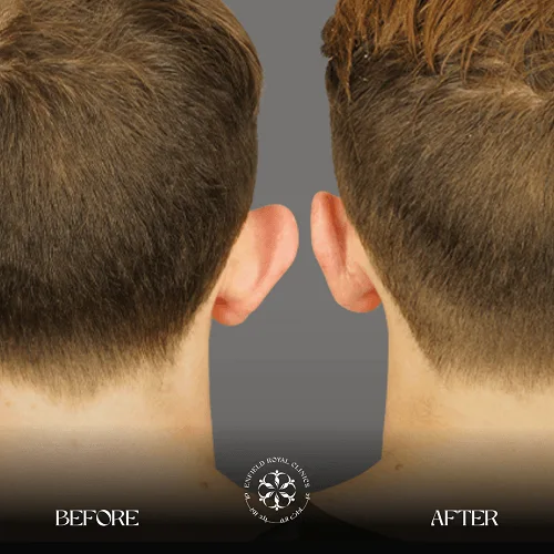 Ear reshaping Before After