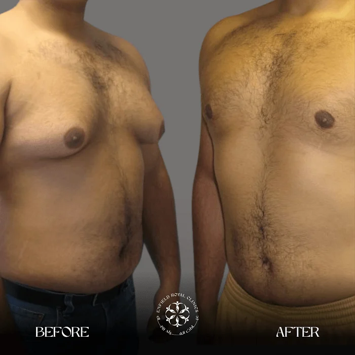 Gynecomestia before after results