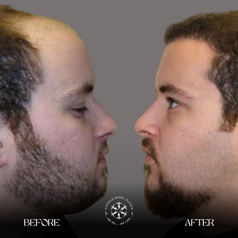Cosmetic Surgery in Riyadh | Enfield Royal Saudia 7 Hair Transplant Before After