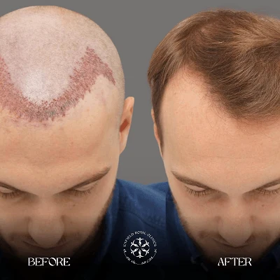 Hair Transplant Before After