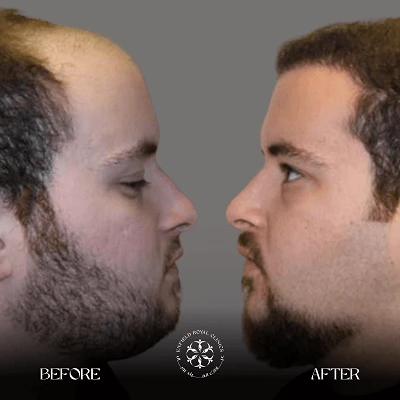 Hair Transplant before after images photos