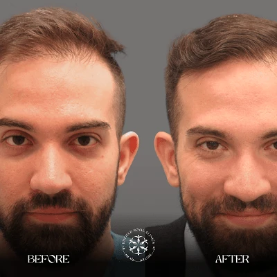 Hair Transplant before after results