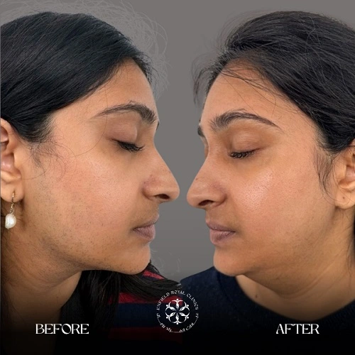 Laser hair remove Before After