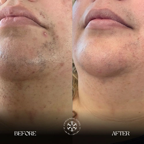 Laser hair remove Before After