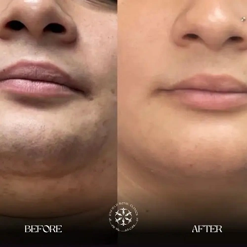 Laser hair remove Before After