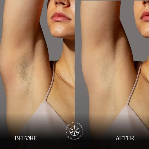 Laser hair remove Before After