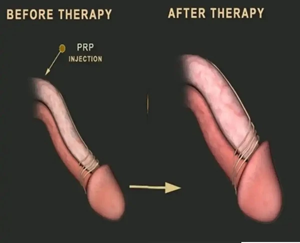 P Shot before after results