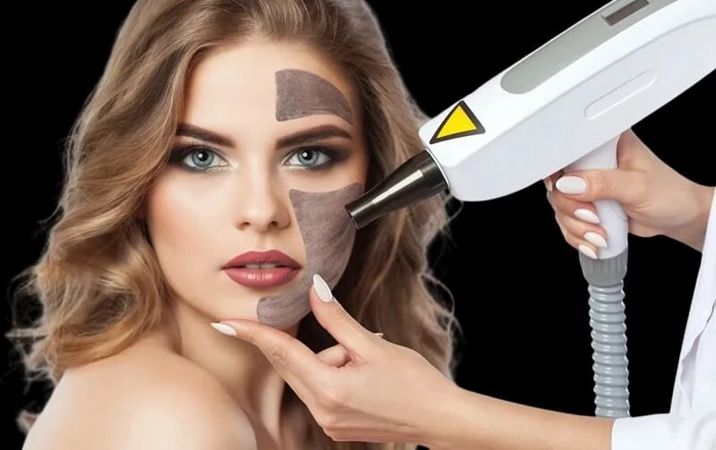 Electrolysis Hair Removal in Riyadh 3 Q-switched Laser in Riyadh