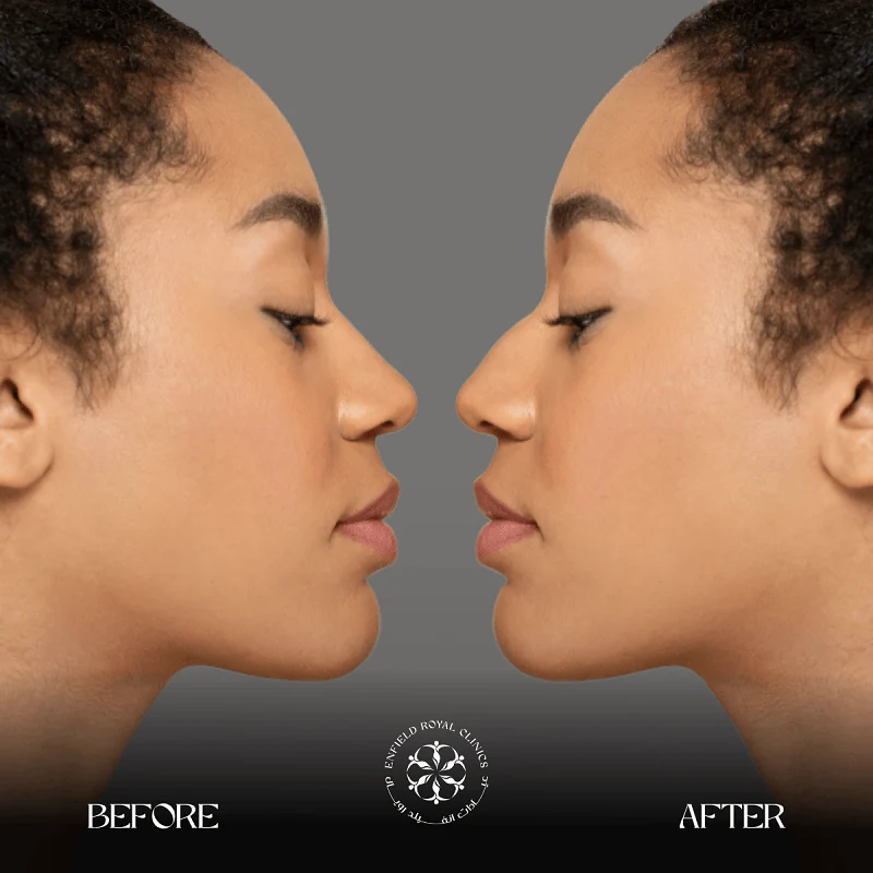 Rhinoplasty Before After