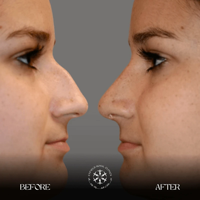 Rhinoplasty before after results