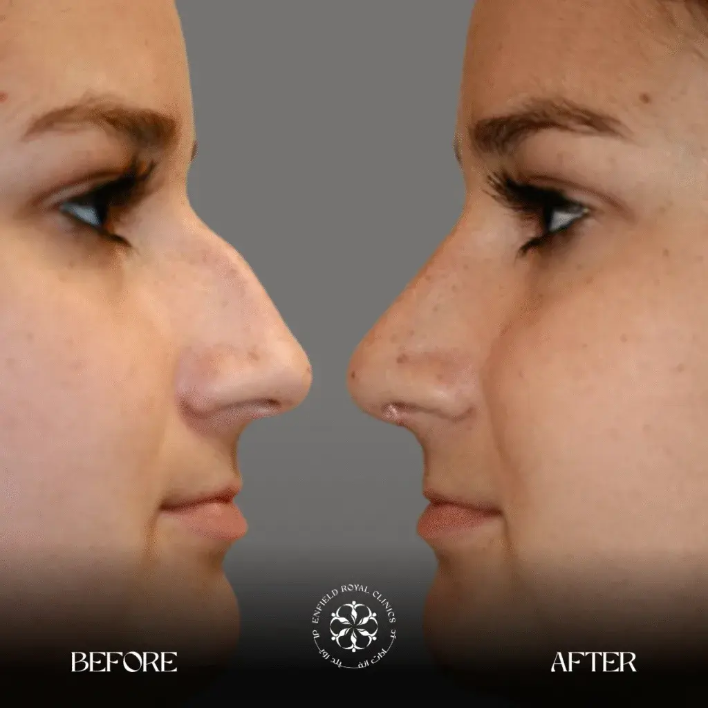 Rhinoplasty-before-after