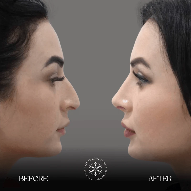 Cosmetic Surgery in Riyadh | Enfield Royal Saudia 6 Rhinoplasty surgery before after