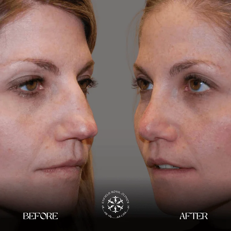 Rhinoplasty surgery results