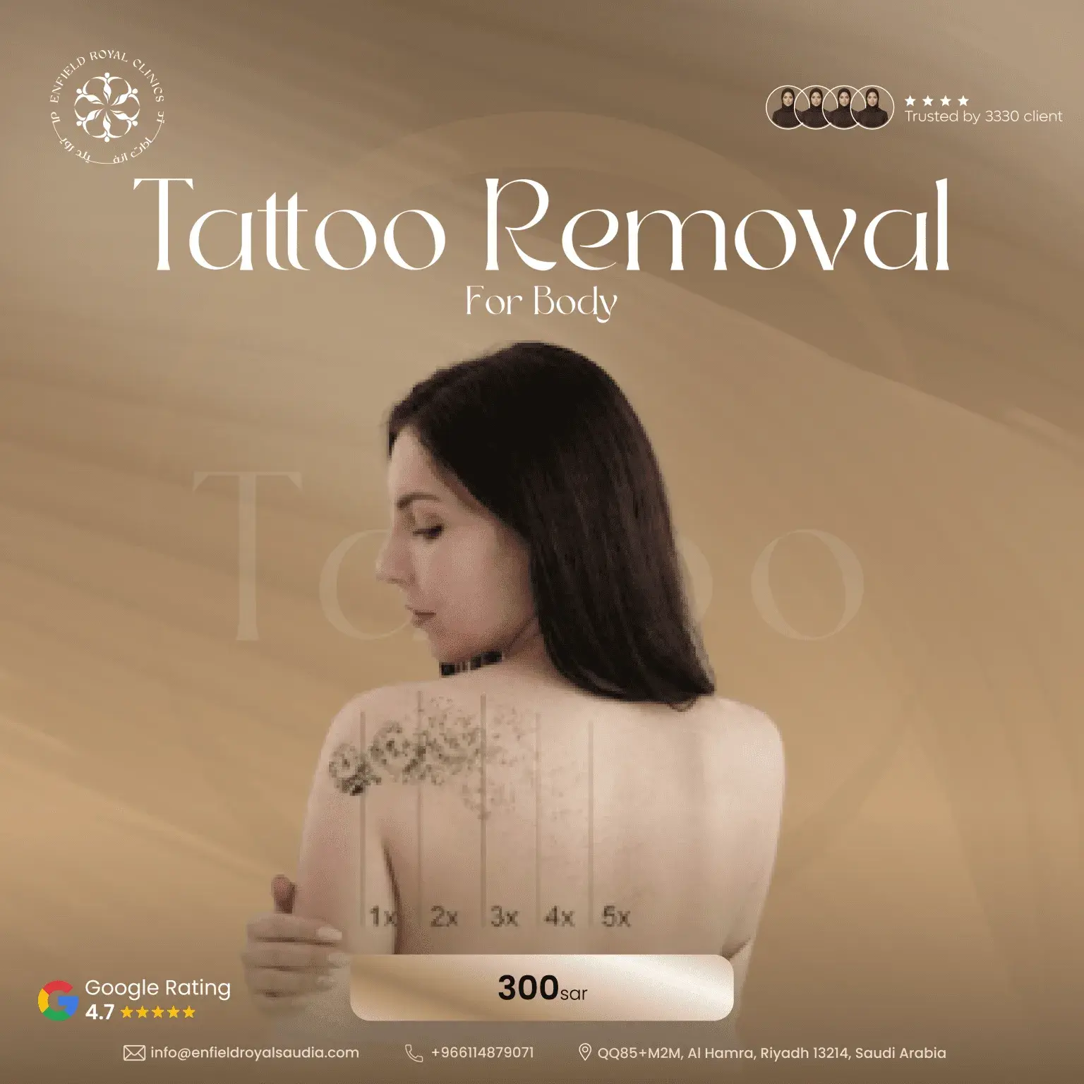 Tattoo-Removal