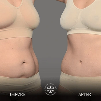 Tummy tuck before and after