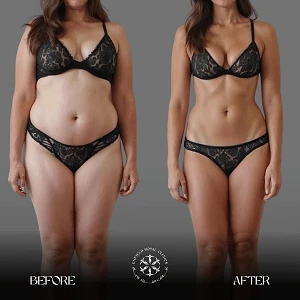 liposuction Before after results