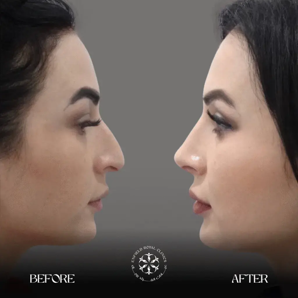 rhinoplasty in riyadh
