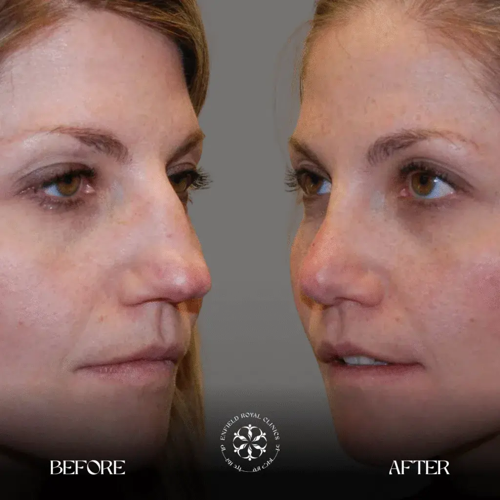 rhinoplasty nose reshapoing