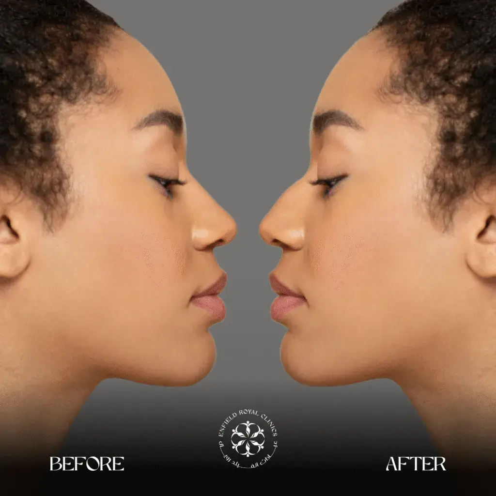 rhinoplasty-riyadh