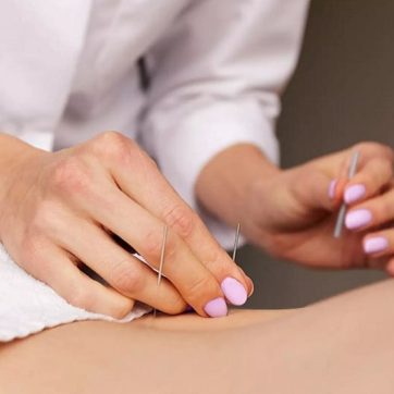 How Much Acupuncture Treatment Cost in Riyadh